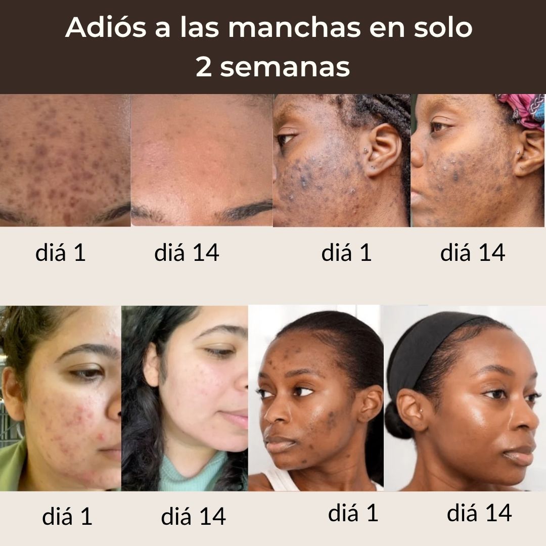 Pads anti-imperfecciones naturales (Curcumina + Ácido Kójico)