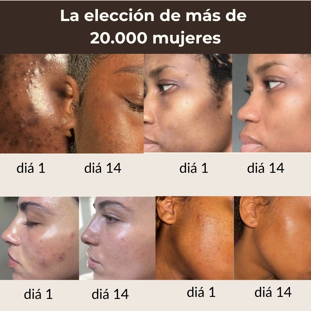 Pads anti-imperfecciones naturales (Curcumina + Ácido Kójico)