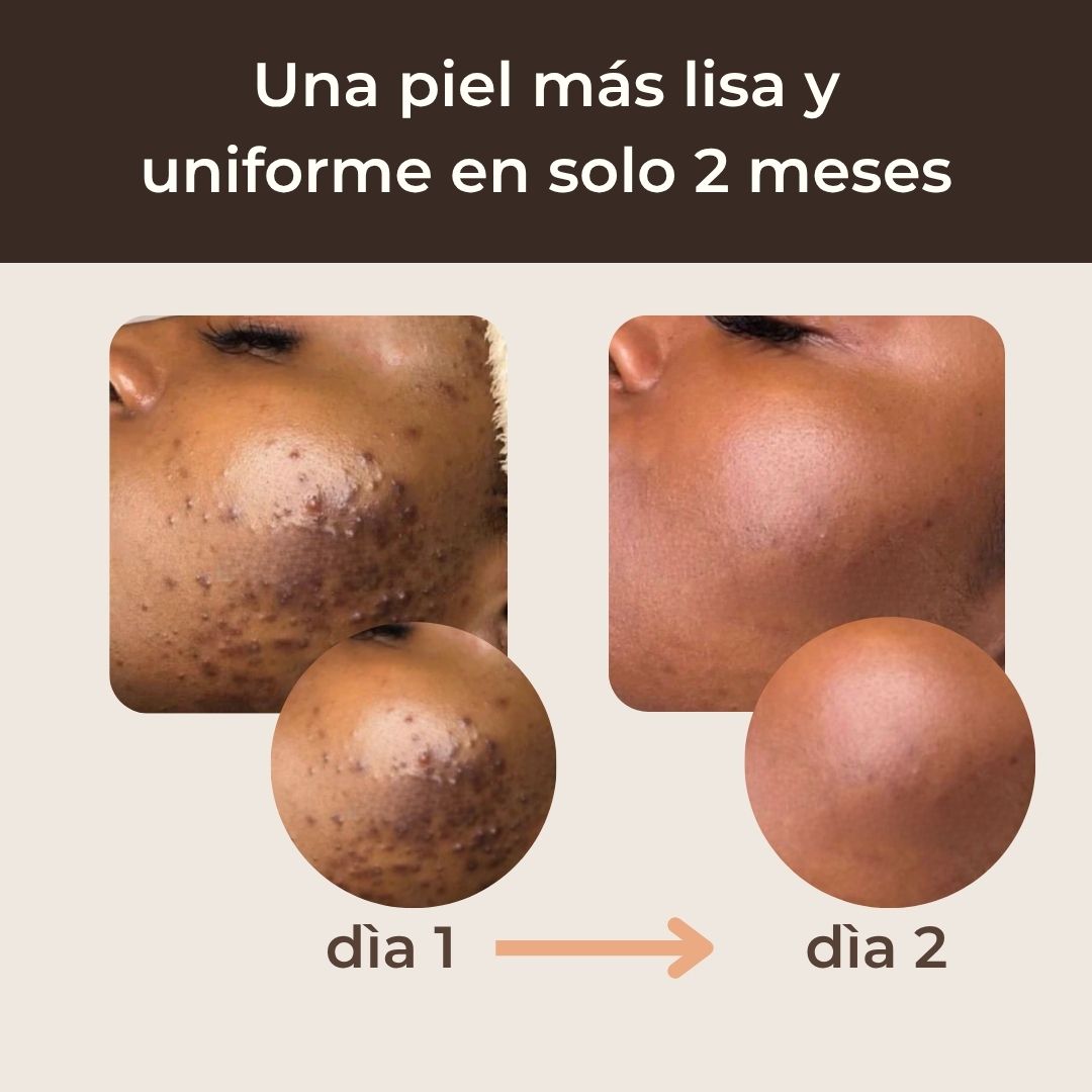 Pads anti-imperfecciones naturales (Curcumina + Ácido Kójico)