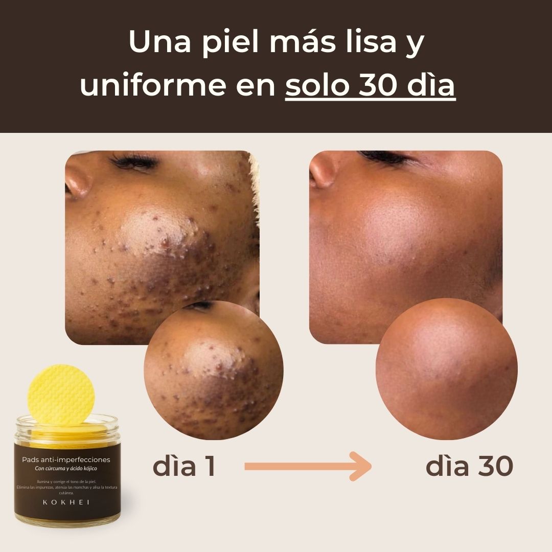 Pads anti-imperfecciones naturales (Curcumina + Ácido Kójico)