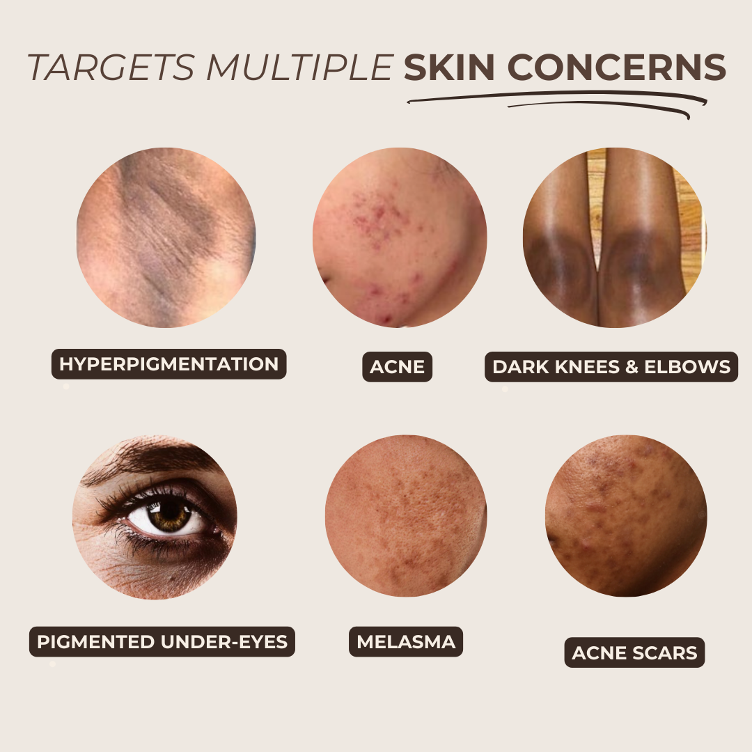 Pads anti-imperfecciones naturales (Curcumina + Ácido Kójico)