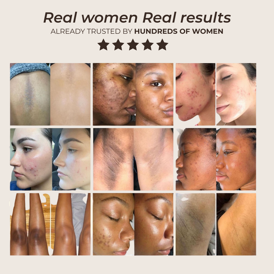 Pads anti-imperfecciones naturales (Curcumina + Ácido Kójico)
