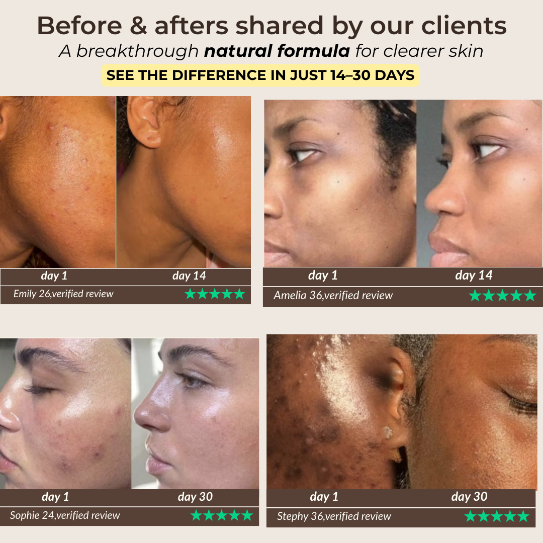 Pads anti-imperfecciones naturales (Curcumina + Ácido Kójico)
