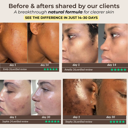 Pads anti-imperfecciones naturales (Curcumina + Ácido Kójico)